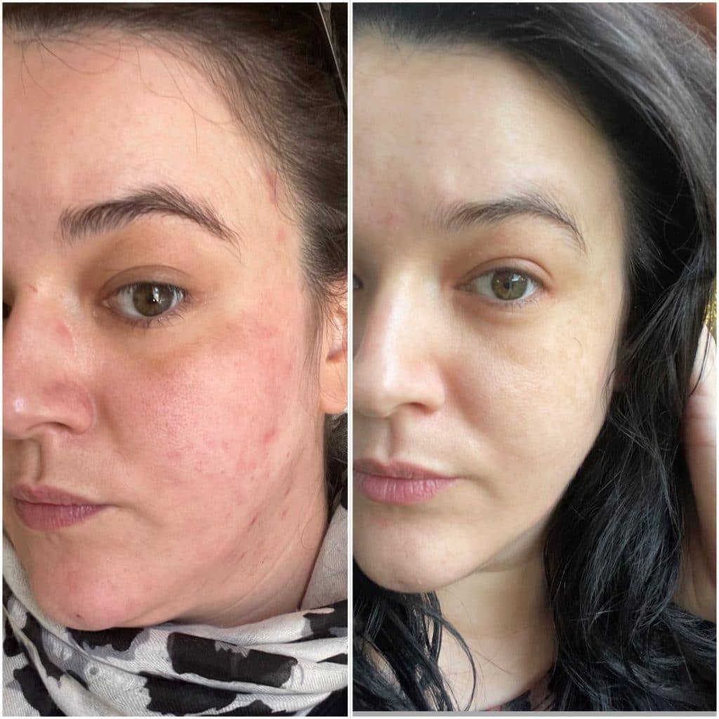 Qr8 MediSkin Review Before and After