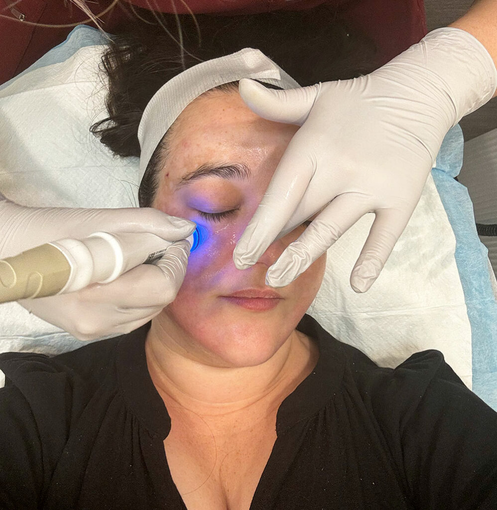 A woman's face in close up as she has a microdermabraision pen applied 
